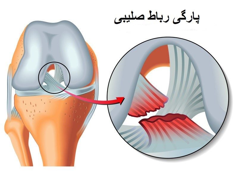 ترمیم پارگی رباط صلیبی و مینیسک زانو با روش های مدرن