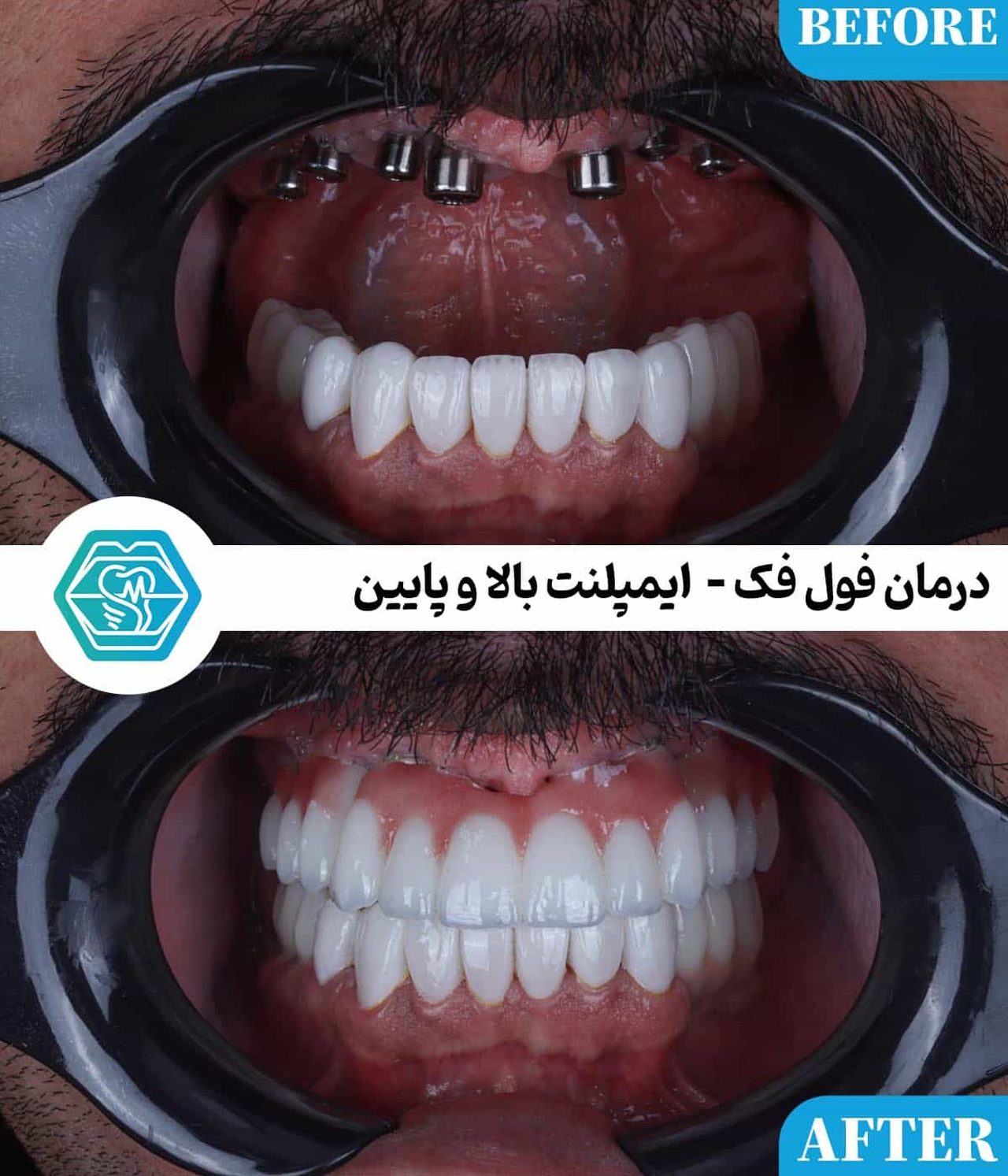 آیا هر فردی میتواند ایمپلنت دندان انجام دهد؟ بررسی شرایط، محدودیتها و باورهای اشتباه