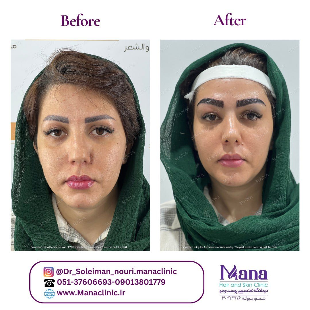 بهترین کلینیک برای کاشت ابرو در مشهد کدام است؟