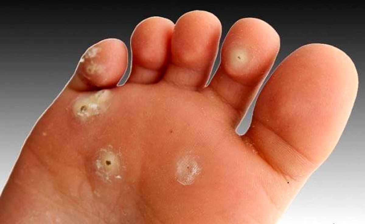 میخچه پا چیست و چگونه درمان می‌شود؟