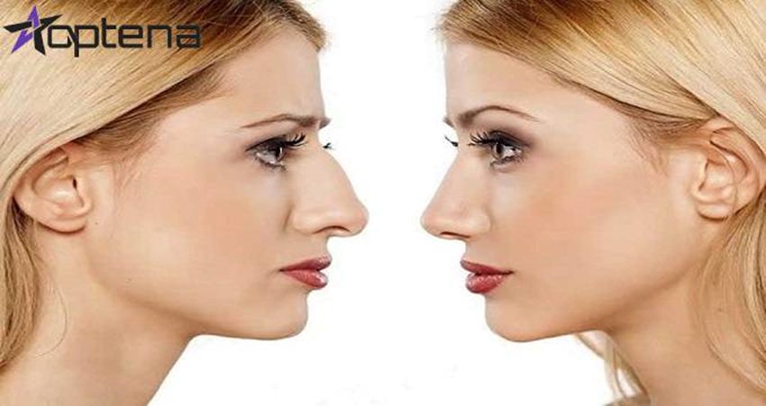 سن مناسب برای جراحی بینی گوشتی