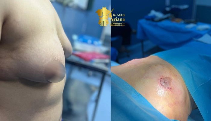 جراحیهای تخصصی پستان در افراد ترنس؛ از تخلیه تا ترمیم و بازسازی سینه