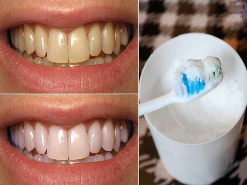 جرم گیری دندان به روش سنتی با جوش شیرین