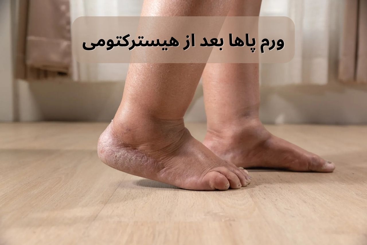 ورم پاها بعد از جراحی سرطان رحم