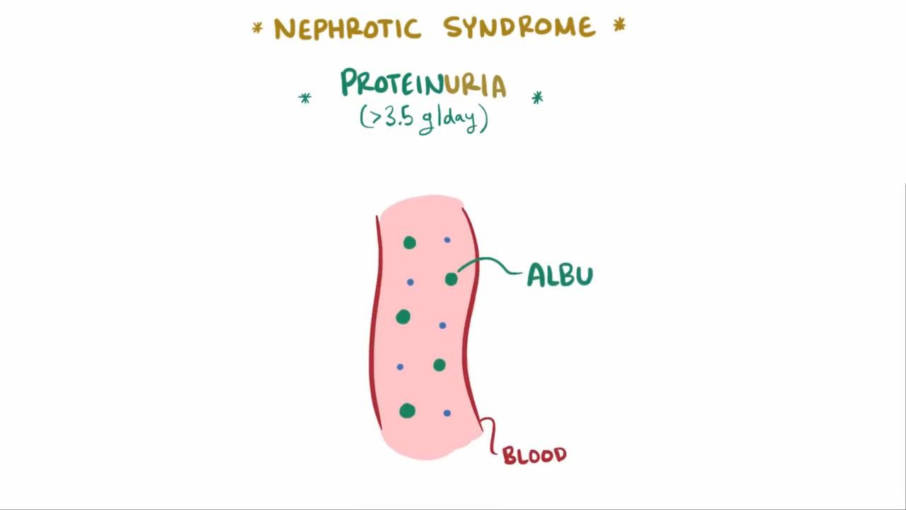 Membranoproliferative glomerulonephritis