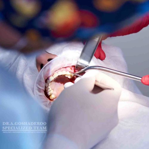لیفت سینوس پیش از کاشت ایمپلنت دندان