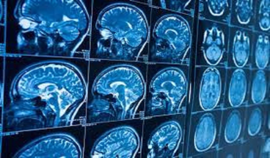 درمان آسیب‌های مغزی با یک فناوری نوین