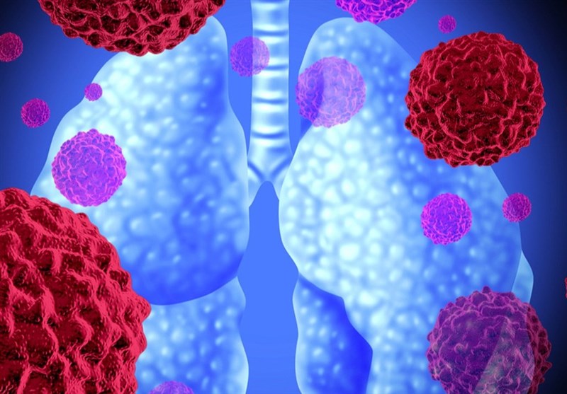 تشخیص زودهنگام سرطان کشنده ریه توسط محققان ایرانی