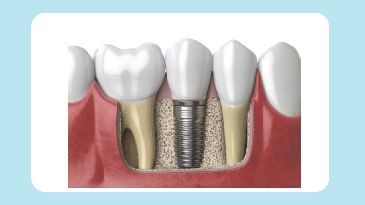 بهترین و کم خطرترین روش جایگزین کردن دندان از دست رفته! آنچه باید راجع به کاشت دندان بدانید!