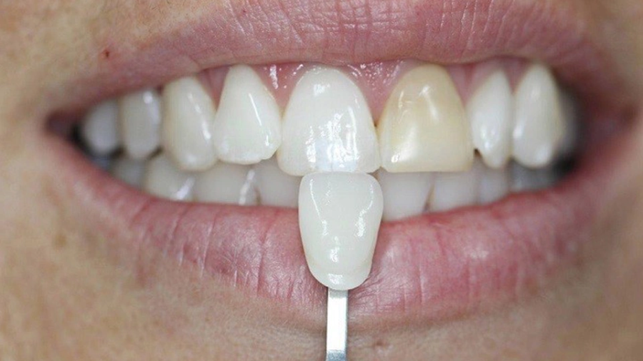 چگونه دندان لمینت را تمیز کنیم؟
