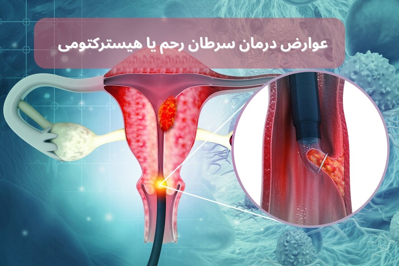 عوارض درمان سرطان رحم یا هیسترکتومی: راهنمای جامع برای زنان