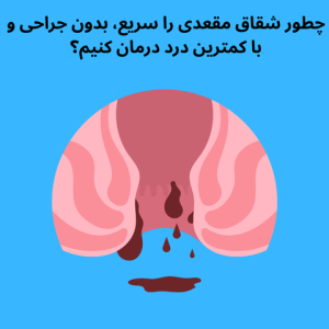 چطور شقاق مقعدی را سریع، بدون جراحی و با کمترین درد درمان کنیم؟ | راهنمای کامل روش لیزر و داروی موضعی