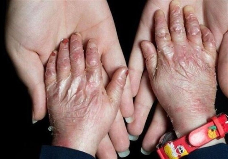 سهمیه تابستان پانسمان‌های تخصصی به خانه EB تحویل شد