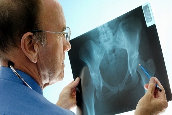 راهاندازی کلینیکهای مدیریت شکستگی برای پیشگیری از پوکی استخوان