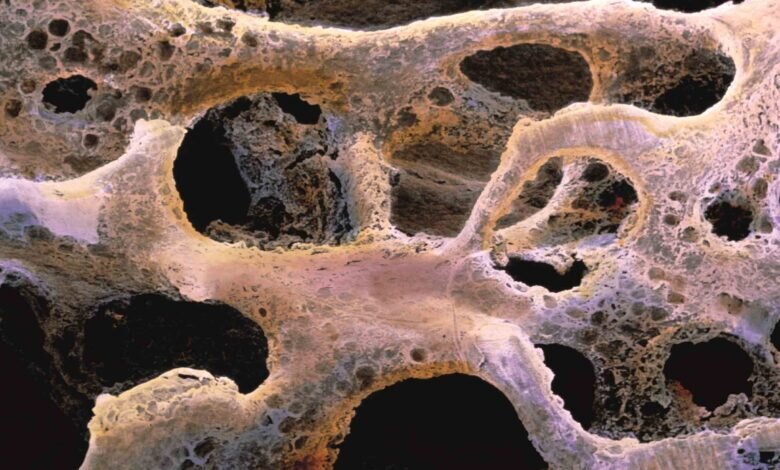 هشدار؛ ابتلای ۳۰ درصد از زنان بالای ۵۰ سال به پوکی استخوان