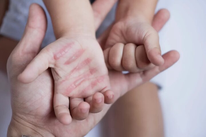 سوختگی؛ آسیب جسمی و روانی که فراتر از درمان است