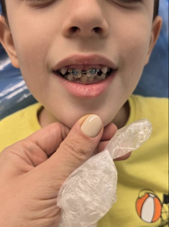 بهترین سن ارتودنسی کودکان