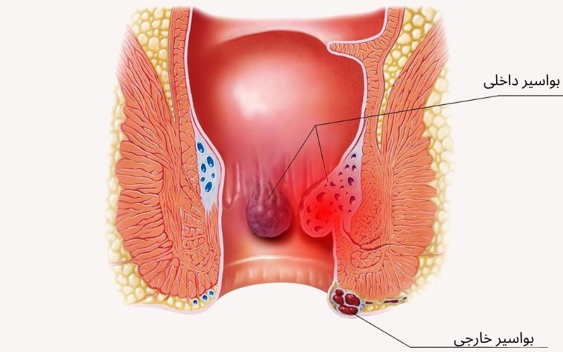 درمان انواع بواسیر در هیوا لیزر