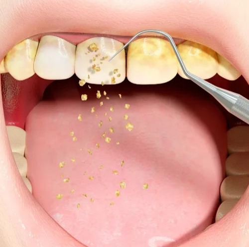 عدم جرم‌ گیری به‌ موقع، ۵ برابر هزینه‌ های درمان را افزایش می‌ دهد