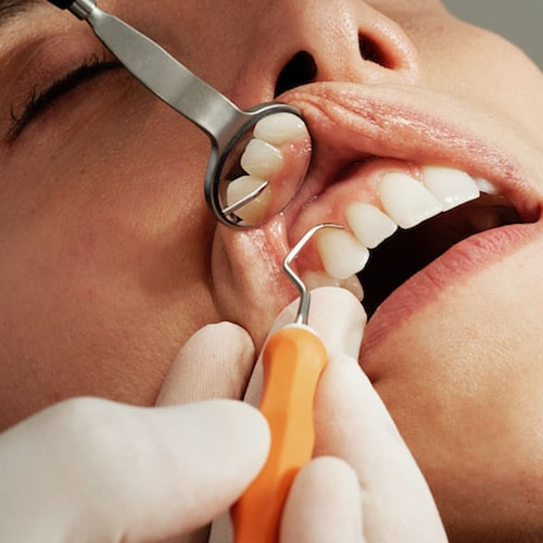 قیمت جرم گیری دندان