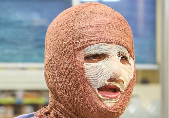 آیا بهبود کامل پس از سوختگی‌های عمیق امکان‌پذیر است؟